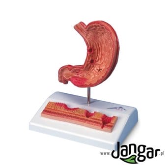 Model żołądka człowieka z owrzodzeniem