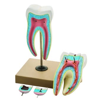 molar model with 3 phases of caries, 6 pcs, 8x